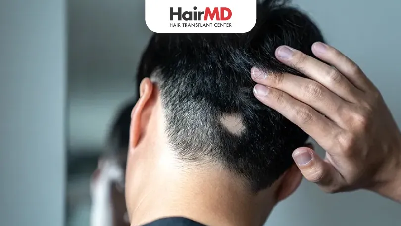 Understanding the Causes of Alopecia Areata HairMD Pune