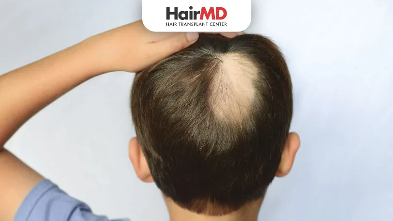 What are the Causes of Alopecia Areata in Children HairMD Pune