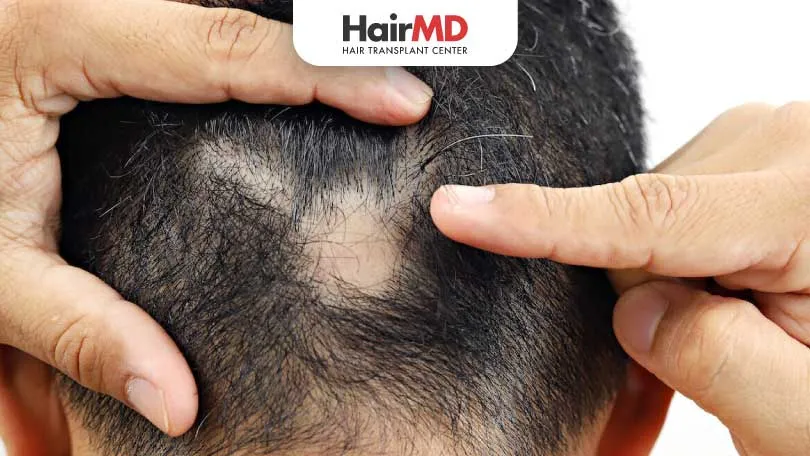 What are the Home Remedies for Alopecia Areata HairMD Pune