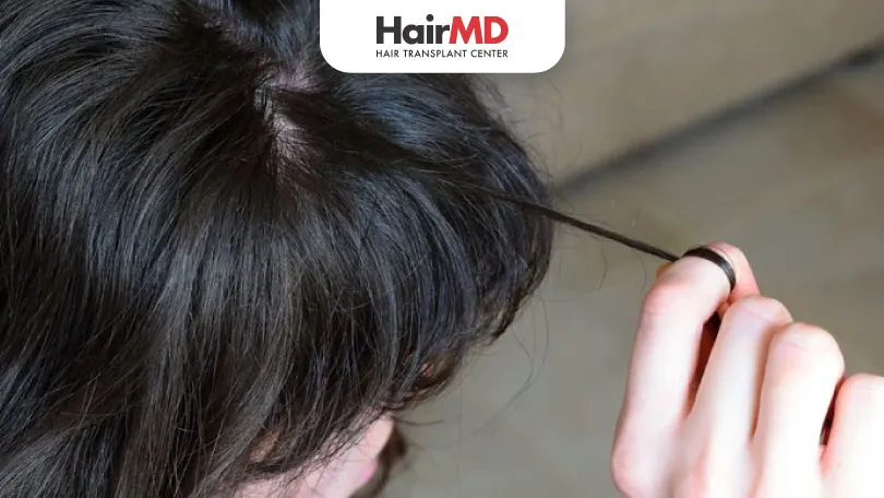 What are the Permanent Solutions for Hair Pulling Disorder HairMD Pune