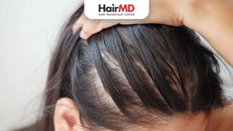 What are the Signs of Hair Loss?