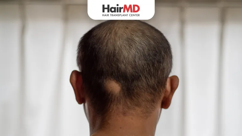 What are the Types of Alopecia Areata HairMD Pune