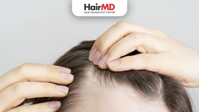 What are the Types of Hair Loss in Females HairMD Pune