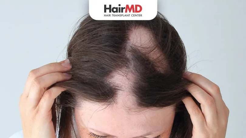 What is Alopecia Areata HairMD Pune