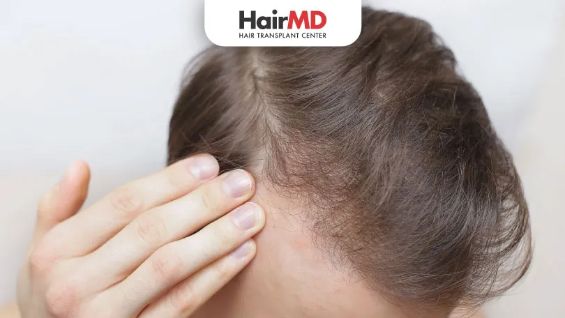 What is Traction Alopecia HairMD Pune