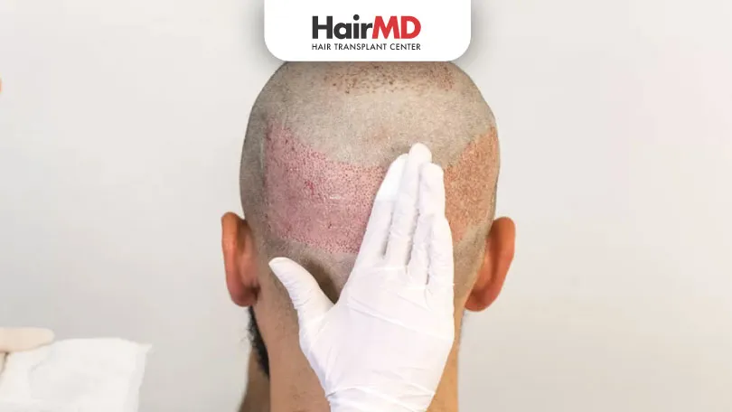 What medications should be taken after a hair transplant?