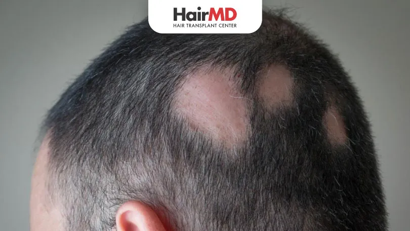 Why Patchy Hair Loss HairMD Pune