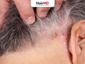 Scalp infection