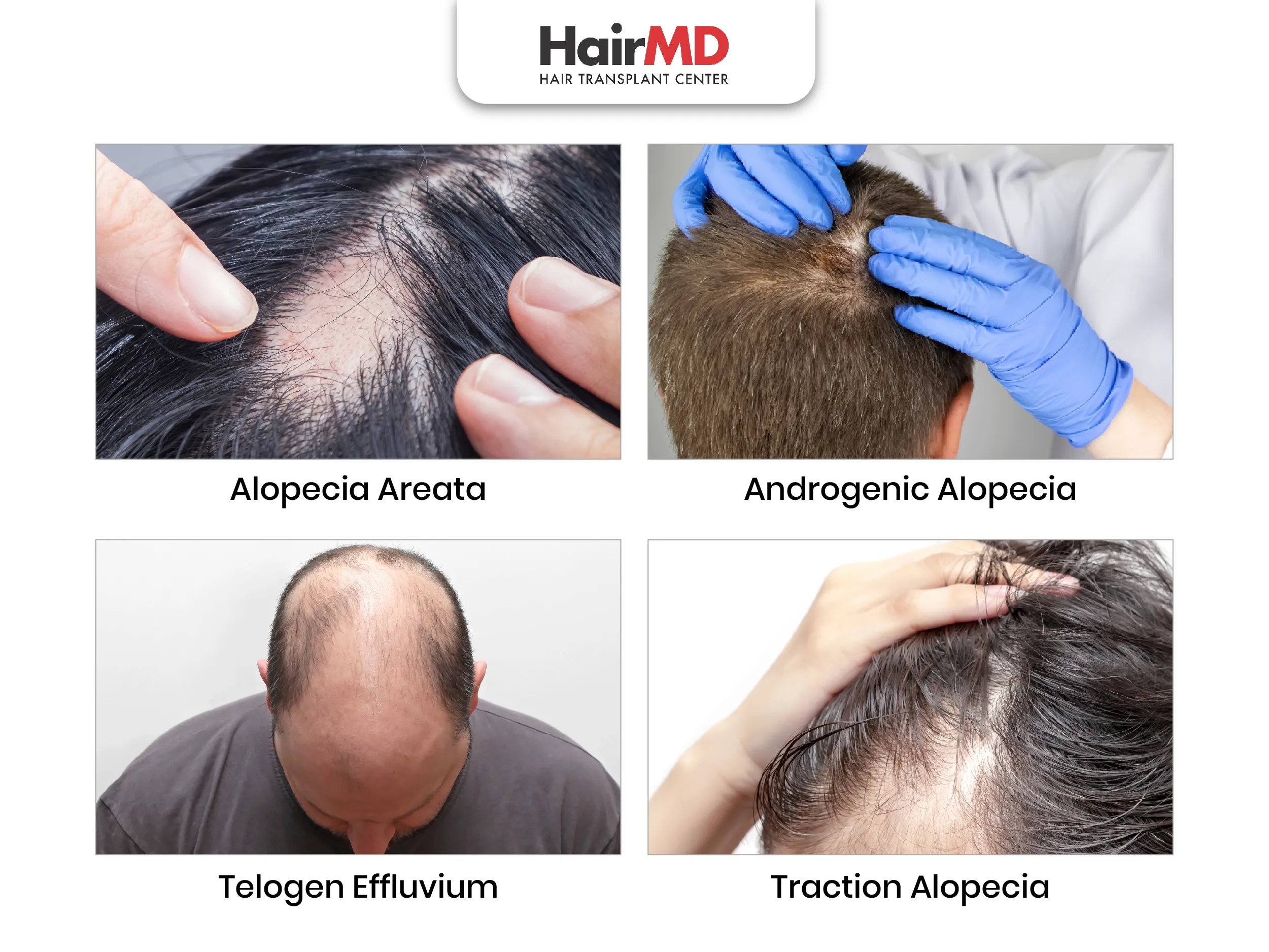 Types of alopecia