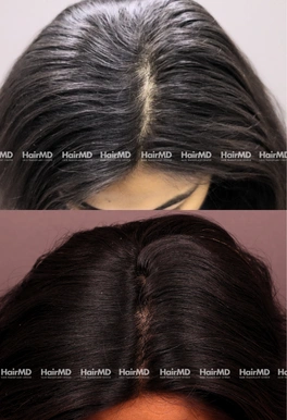 26yrs Female Hairloss Results 6 Months Timeline 7 Sessions HairMD Pune