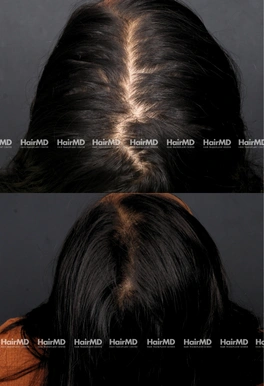 34yrs Female Hairloss Results 6 Months Timeline 6 Sessions HairMD Pune