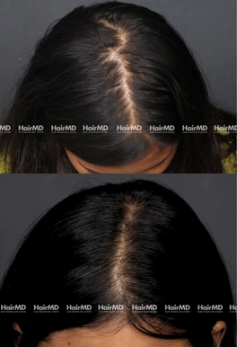 34yrs Female Hairloss Results 6 Months Timeline 6 Sessions HairMD Pune