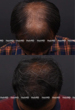 37yrs Male Hairloss Results 6 Months Timeline 7 Sessions HairMD Pune