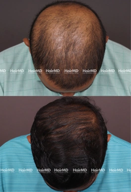 38yrs Male Hairloss Results 6 Months Timeline 6 Sessions HairMD Pune