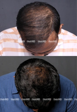 40yrs Male Hairloss Results 6 Months Timeline 7 Sessions HairMD Pune