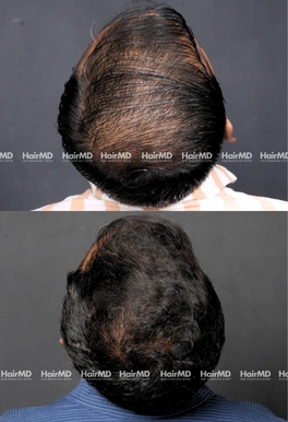 40yrs Male Hairloss Results 6 Months Timeline 7 Sessions HairMD Pune