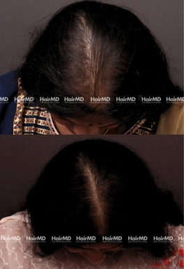 43yrs Female Hairloss Results 6 Months Timeline 7 Sessions HairMD Pune