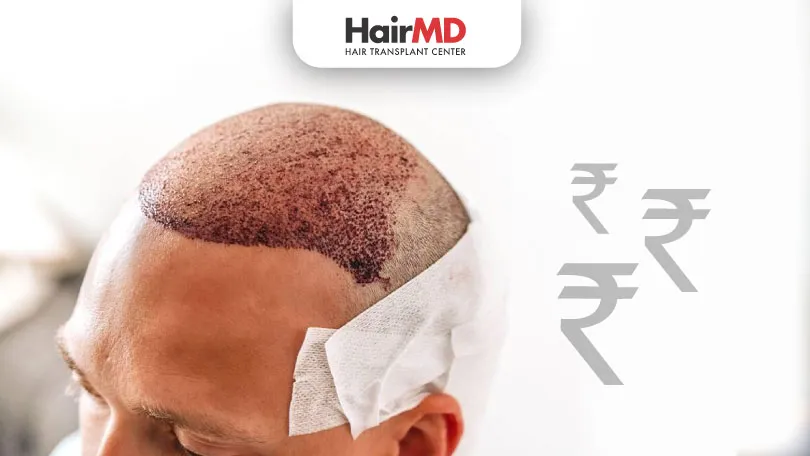 What is the Cost for Hair Transplant in India?