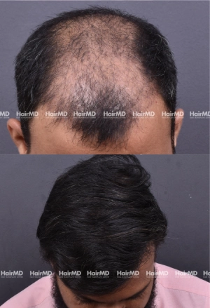 36yrs Male Hairtransplant Results 2 Years 3000-4000 Grafts HairMD Pune