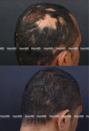 40yrs Alopecia Areata Hairloss Results 6 Months Timeline 7 Sessions HairMD Pune