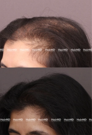 45yrs Female Hairloss Results 6 Months Timeline 8 Sessions HairMD Pune